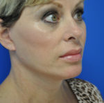 Facelift