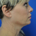 Facelift