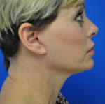 Facelift