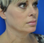 Facelift