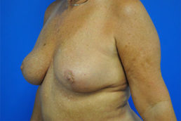 Breast Implant Removal Case 4964 After Photo Breast Implant Removal