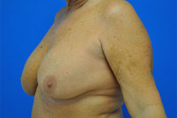 Breast Implant Removal Case 4964 Before Photo Breast Implant Removal