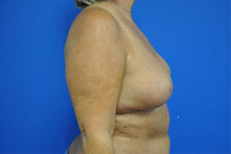 Breast Implant Removal Case 4964 After Photo Breast Implant Removal