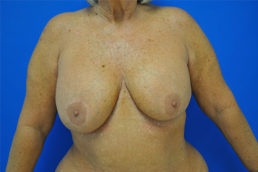 Breast Implant Removal Case 4964 Before Photo Breast Implant Removal