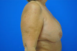 Breast Implant Removal Case 4964 Before Photo Breast Implant Removal