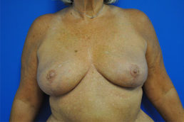 Breast Implant Removal Case 4964 After Photo Breast Implant Removal