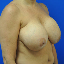 Breast Implant Removal Case 4972 Before Photo Breast Implant Removal