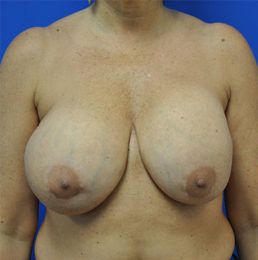 Breast Implant Removal Case 4972 Before Photo Breast Implant Removal
