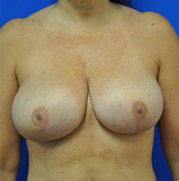 Breast Implant Removal Case 4972 After Photo Breast Implant Removal