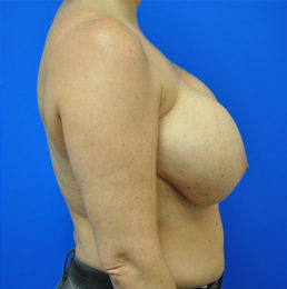 Breast Implant Removal Case 4972 Before Photo Breast Implant Removal