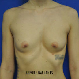Breast Implant Removal Case 4986 Before Photo Breast Implant Removal