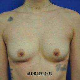 Breast Implant Removal Case 4986 After Photo Breast Implant Removal