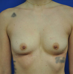 Breast Implant Removal Case 4986 After Photo Breast Implant Removal