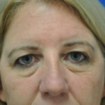 Eyelid Surgery