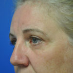 Eyelid Surgery