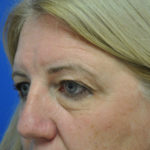 Eyelid Surgery