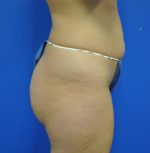 Buttock Shaping (Brazilian Butt Lift)