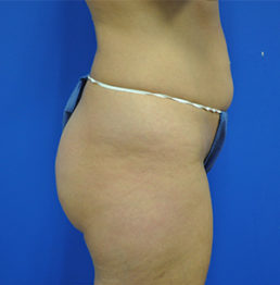 Buttock Shaping (Brazilian Butt Lift) Case 5075 Before Photo Buttock Shaping (Brazilian Butt Lift)