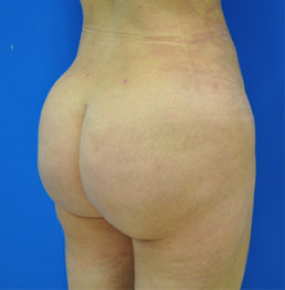 Buttock Shaping (Brazilian Butt Lift) Case 5075 After Photo Buttock Shaping (Brazilian Butt Lift)