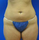 Buttock Shaping (Brazilian Butt Lift)