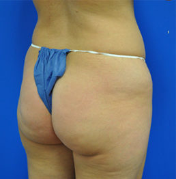 Buttock Shaping (Brazilian Butt Lift) Case 5075 Before Photo Buttock Shaping (Brazilian Butt Lift)