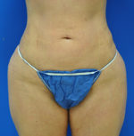 Buttock Shaping (Brazilian Butt Lift)