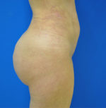 Buttock Shaping (Brazilian Butt Lift)