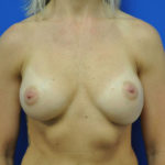Revisional & Corrective Breast Augmentation