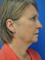 Facelift