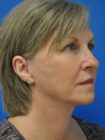 Facelift
