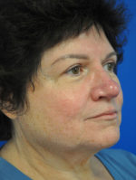 Facelift