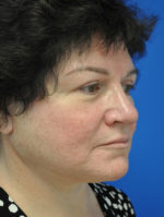 Facelift