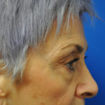 Eyelid Surgery