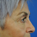 Eyelid Surgery