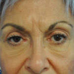Eyelid Surgery