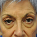 Eyelid Surgery