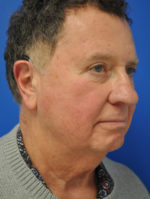 Facelift