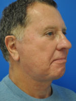 Facelift