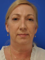 Facelift