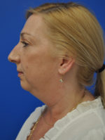 Facelift
