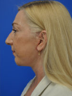 Facelift