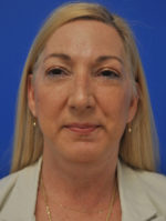 Facelift
