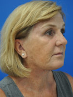 Facelift
