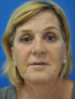 Facelift