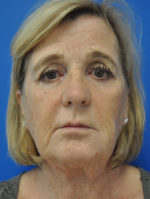 Facelift