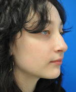 Rhinoplasty