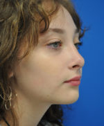 Rhinoplasty