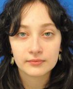 Rhinoplasty