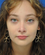 Rhinoplasty