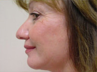 Chin Implants After - Woman Side View
